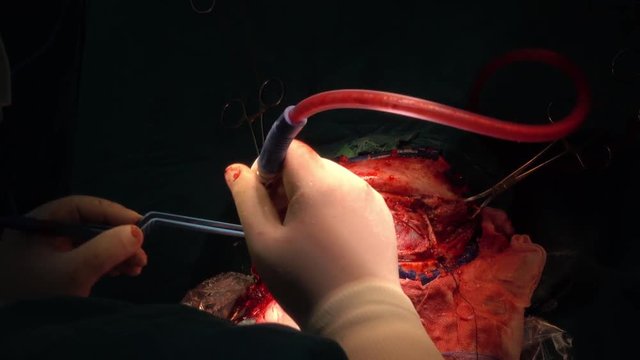 neurosurgeon perform craniotomy for patient