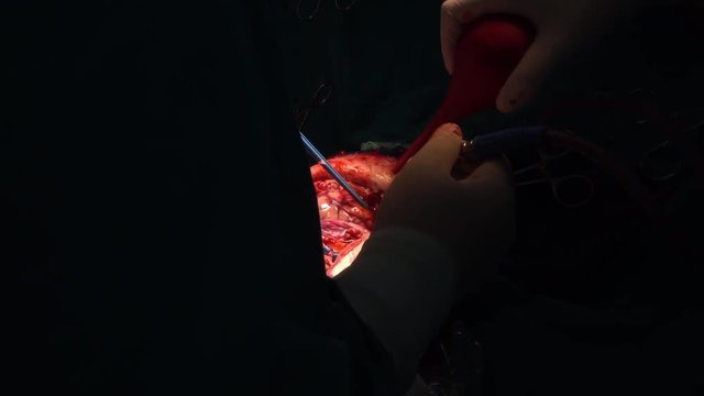 neurosurgeon perform craniotomy for patient
