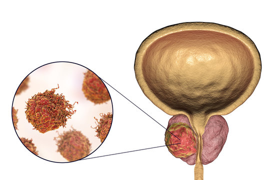 Prostate cancer, 3D illustration showing tumor inside prostate gland and closeup view of cancer cells