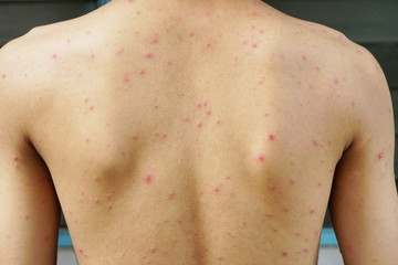 Back side body of a man have spotted, red pimple and bubble rash from chicken pox or varicella zoster virus.