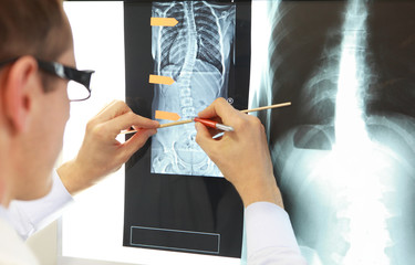 Case study . Doctor working with   images of chest and spine  at x-ray film viewer,....