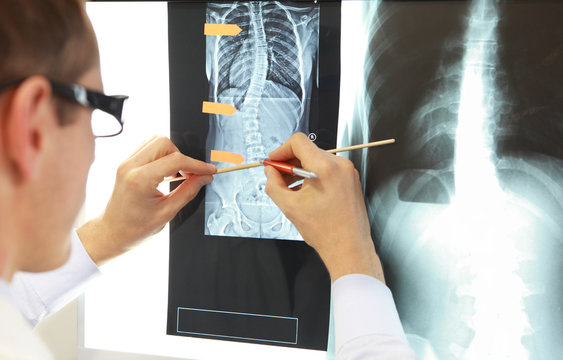 Case study . Doctor working with   images of chest and spine  at x-ray film viewer,. Diagnosis,treatment planning.