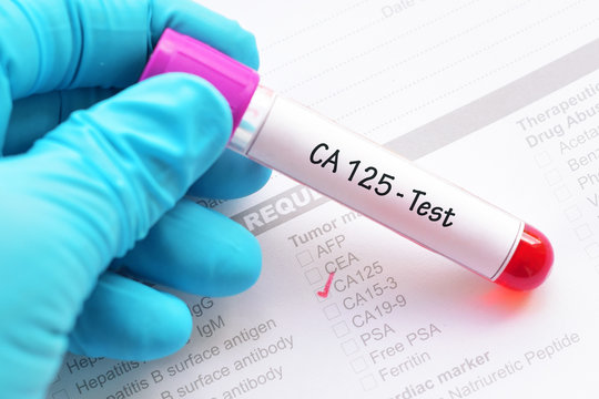 CA 125 test