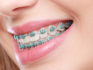 Closeup of woman teeth with braces - obrazy, fototapety, plakaty