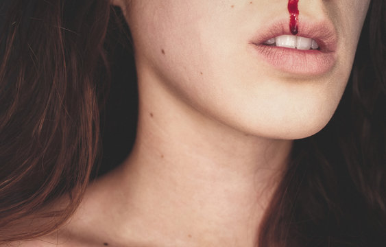 girl with bloody nose