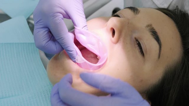 The dentist puts the mouth expander for a beautiful girl in the dental office.