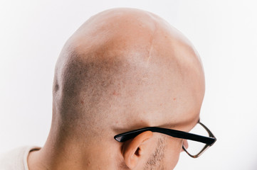 Closeup of bald male head after oncology operation. Brain tumor irradiation and chemotherapy marks....