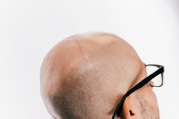 Closeup of bald male head after oncology operation. Brain tumor irradiation and chemotherapy marks. Survivor patient after cancer. Hairless man with scars. Skin irritation. Neurosurgery operation.