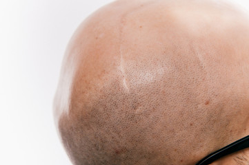 Closeup of bald male head after oncology operation. Brain tumor irradiation and chemotherapy marks. Survivor patient after cancer. Hairless man with scars. Skin irritation. Neurosurgery operation.