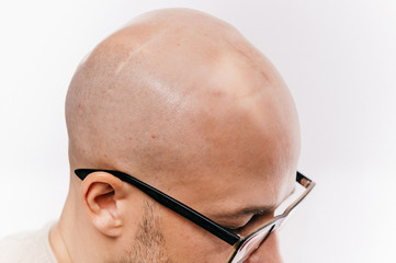 Closeup of bald male head after oncology operation. Brain tumor irradiation and chemotherapy marks....
