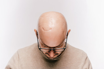 Closeup of bald male head after oncology operation. Brain tumor irradiation and chemotherapy marks....
