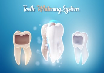 Illustration of 3D Realistic Vector Teeth Cleaning Process. Healthcare Stomatology Procedure