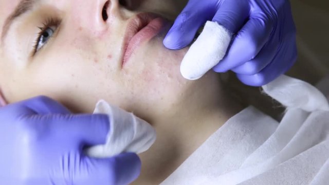 beautician squeezing pimple blackheads for young wonan in beauty salon. facial skin care
