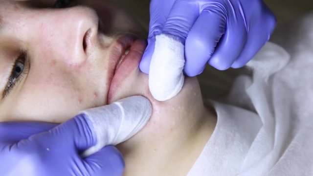 beautician squeezing pimple blackheads for young wonan in beauty salon. facial skin care