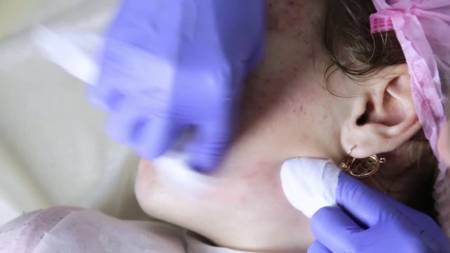 Squeezing pimple acne treatments. Young woman receiving beauty face therapy of cleaning pimple.