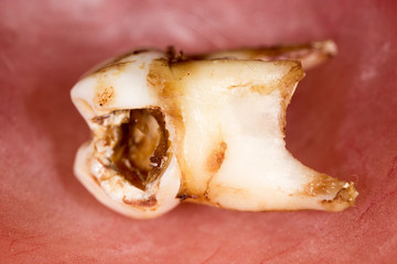 caries in the tooth. macro