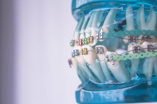 Classic dental metal orthodontics with colored hooks