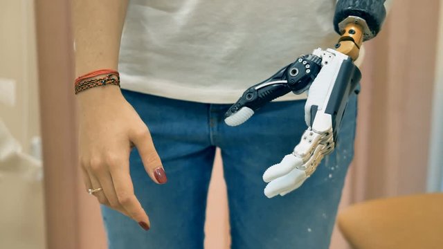 Robotic prosthesis arm connected to a disabled woman hand. 4K.