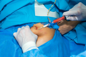 Subcutaneous fat removal. Surgeon's work in the operating theatre.