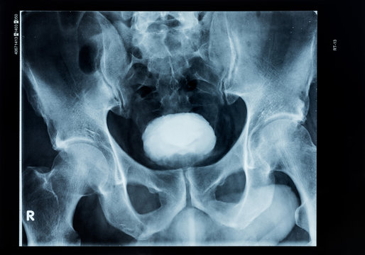 X-Ray Of Human Pelvis And Bladder With Contrast Medium