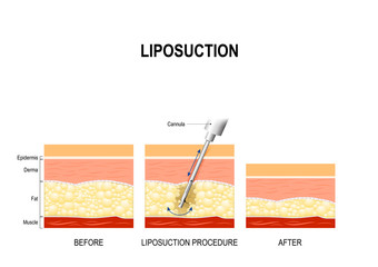 liposuction procedure. Before and after - obrazy, fototapety, plakaty