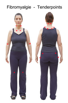 Fibromyalgie Tender Points Tenderpoints Frau