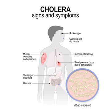  cholera. Signs and symptoms.