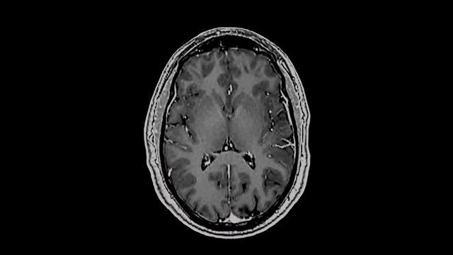 MRI brain scan,magnetic resonance imaging of a brain, ultra hd 4k, time lapse