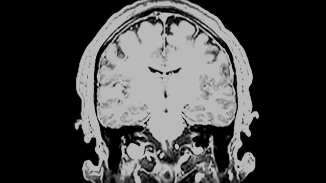 MRI brain scan,magnetic resonance imaging of a brain, ultra hd 4k, time lapse