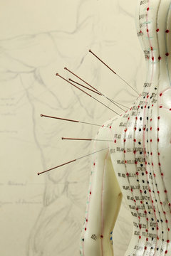 female acupuncture model with needles in the shoulder