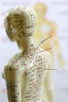 female acupuncture model with needles in the shoulder