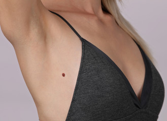 Checking benign moles : Beautiful Woman with birthmarks on her skin. Laser skin tags removal