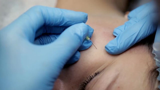 The beautician pierces the needle with the needle on the girl's face. The procedure of mechanical face cleaning