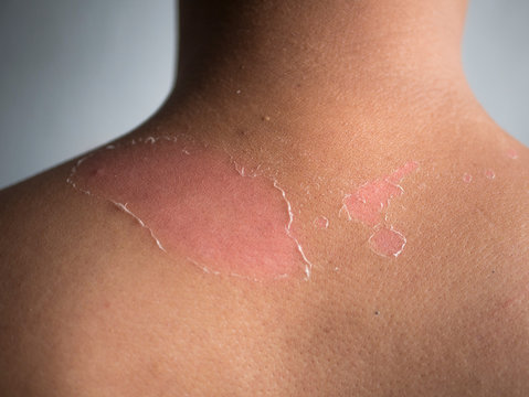 peeling skin at back and shoulder from sunburn effect on body of young man from sunbath at summer. dangerous sunburn concept