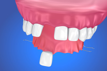 Single Missing Tooth - Removable partial denture .  3D illustration