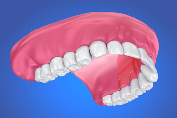 Single Missing Tooth - Removable partial denture .  3D illustration