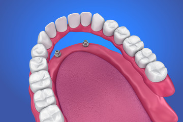 Fixed bridge on implants. Medically accurate 3D illustration