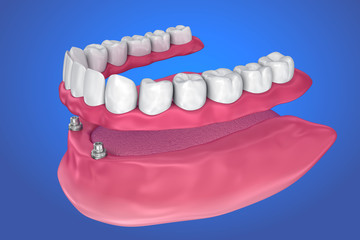 Fixed bridge on implants. Medically accurate 3D illustration