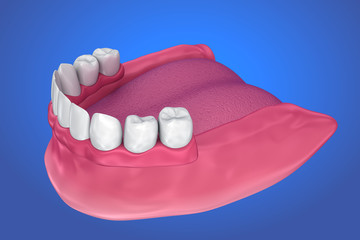 Fixed bridge on implants. Medically accurate 3D illustration