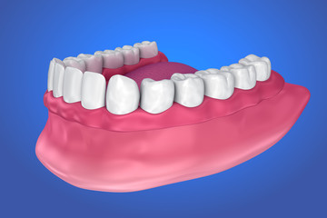 All missing teeth - removable full denture. 3D illustration