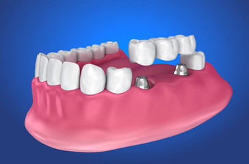 implant supported fixed bridge. Medically accurate 3D illustration