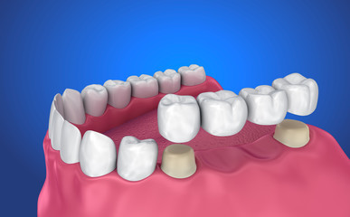 Fototapeta na wymiar Tooth supported fixed bridge. Medically accurate 3D illustration