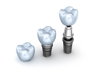 Tooth Implants set isolated on white background 3D illustration
