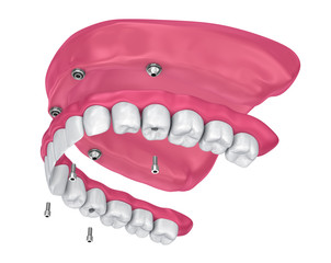 Overdenture to be seated on implants attachments. 3D illustration
