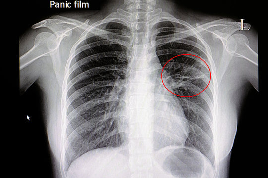 Chest x-ray film of patient with pneumonia