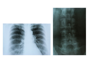 X-rays of the lungs and  lumbar spine isolated on a white background. 8 November World Radiography Day.