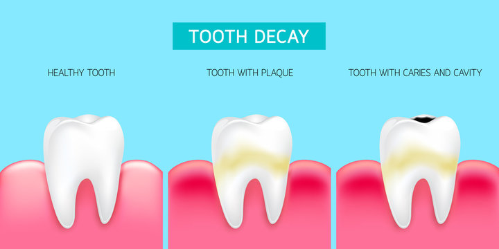 Step of tooth decay formation. Healthy tooth, forming dental plaque and finally caries and cavity. Illustration info-graphic isolated on blue background. Dental care concept.