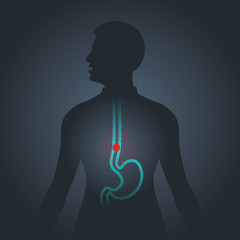 Esophageal Cancer vector logo icon illustration