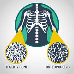 Osteoporosis vector logo icon illustration