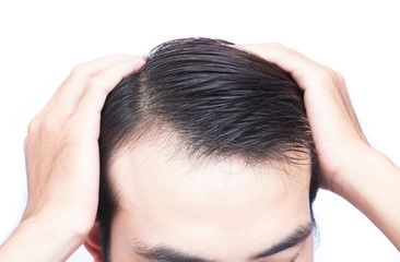 Fototapeta premium Young man serious hair loss problem for health care medical and shampoo product concept